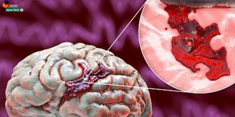 Brain hemorrhage: Know its symptoms and their importance.