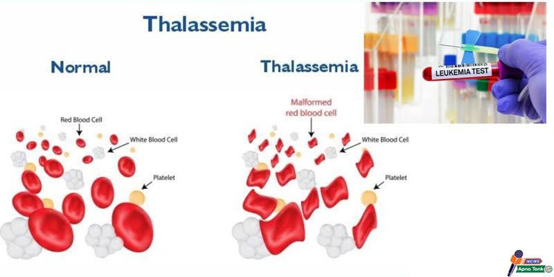Identifying symptoms of thalassemia